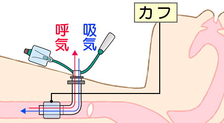 気管切開のカニューレ除去後の人々の見通しはどうなりますか?