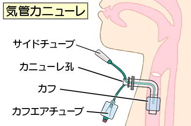 気管切開のカニューレ除去はなぜ行われるのですか?
